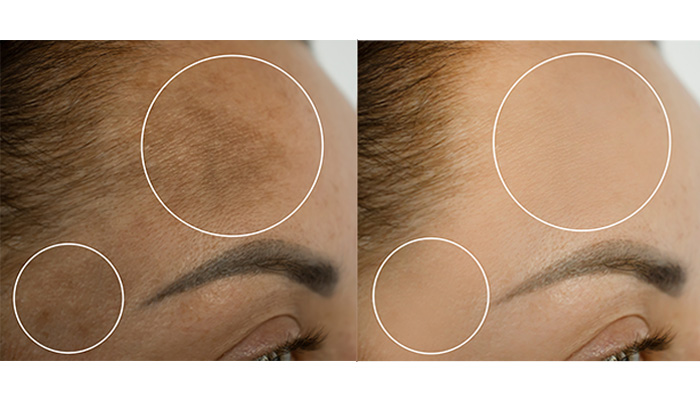dark spots skin